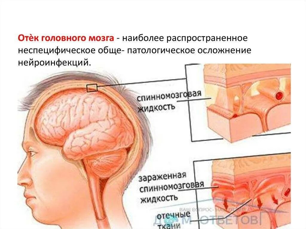 Отек набухание головного мозга. Отек и набухание вещества головного мозга. Отёк и набухание головного мозга. Отеков мозга головы