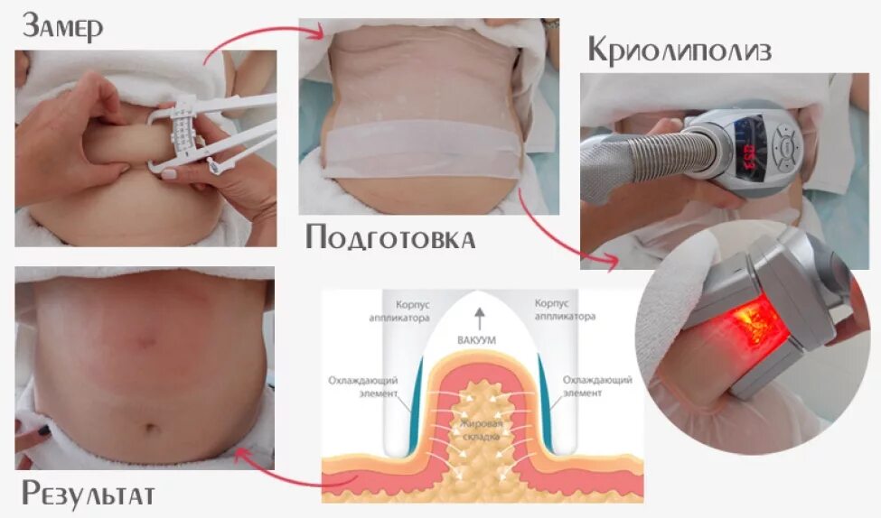 Что делать после криолиполиза. Криолиполиз 360 аппарат. Cocoon аппарат криолиполиз. КРЕАЛИ полис. Криолиполиз насадка.