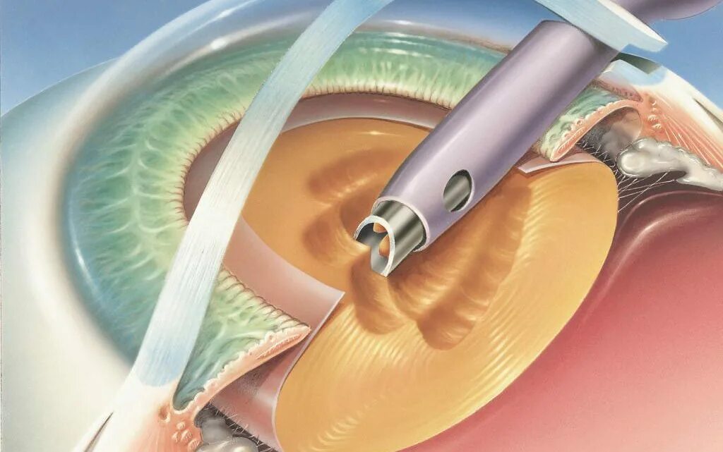 Катаракта восстановление после операции. Интракапсулярная экстракция катаракты. Лазерная экстракция катаракты. Экстракапсулярная экстракция. Лазерная факоэмульсификация катаракты.