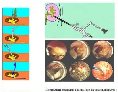Дробление камня в мочевом