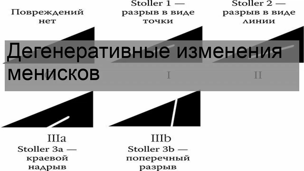 Классификация повреждения менисков по Stoller. Повреждение менисков по Stoller. Повреждение мениска по Stoller.