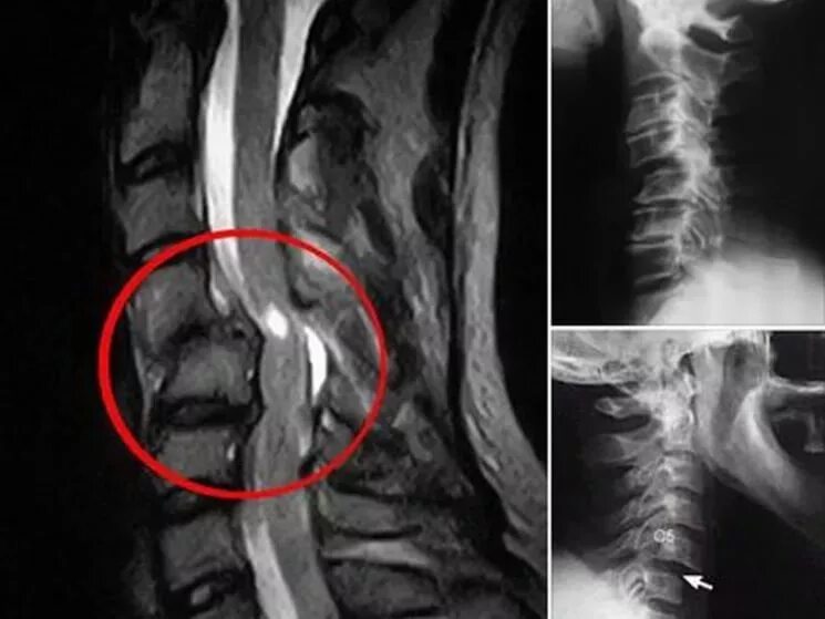 Отдел разрыв. Ушиб позвоночника рентген. Перелом ныряльщика рентген. Перелом шейного позвонка рентген.
