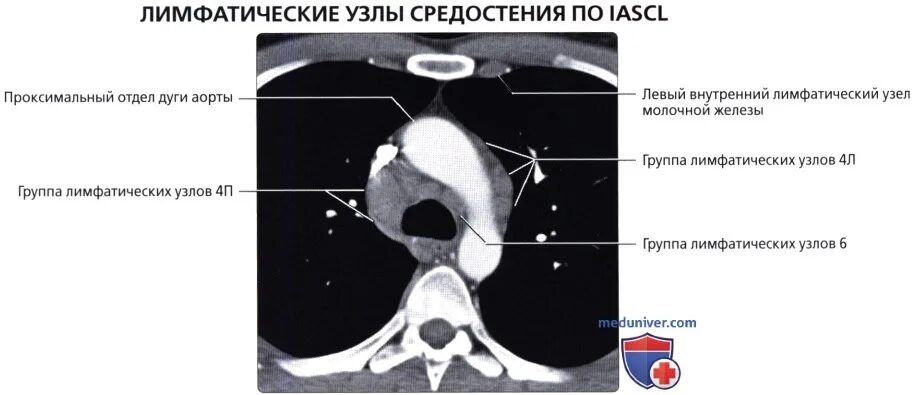 Короткая ось лимфоузла. Лимфатические узлы переднего средостения кт. Лимфоузлы средостения кт норма. Лимфатические узлы средостения норма на кт легких. Кт анатомия лимфатических узлов средостения.