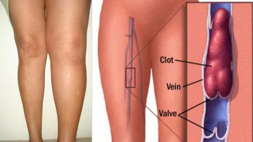 Тромбофлебит Варикотромбофлебит. Илеофеморальный флеботромбоз. Тромбофлебит икроножной мышцы. Чтоб не было тромбы