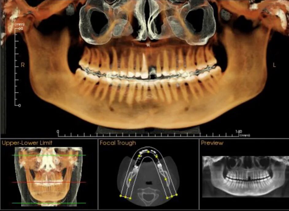 Кт нижней челюсти цена в ульяновске. Компьютерная томография кт челюсти. Компьютерная томография зубов 3d.