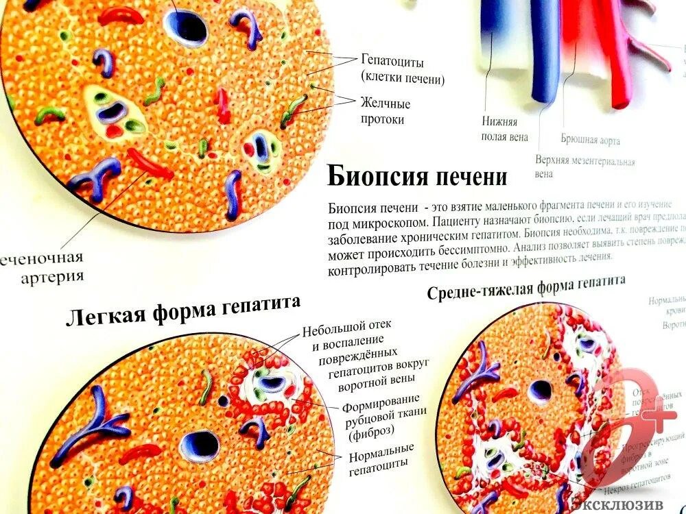 Биопсия печени отзывы. Биопсия печени под микроскопом.