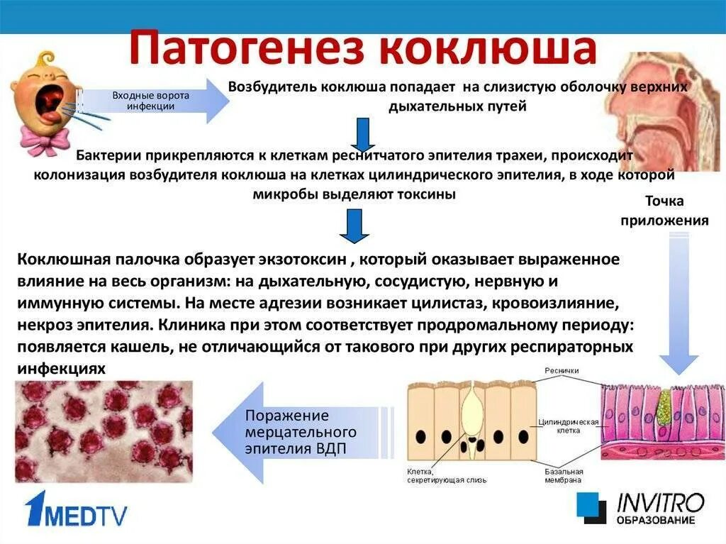 Последствия болезни коклюшем. Коклюш патогенез приступа кашля. Коклюш этиология патогенез. Механизм развития коклюша. Коклюш паракоклюш патогенез.