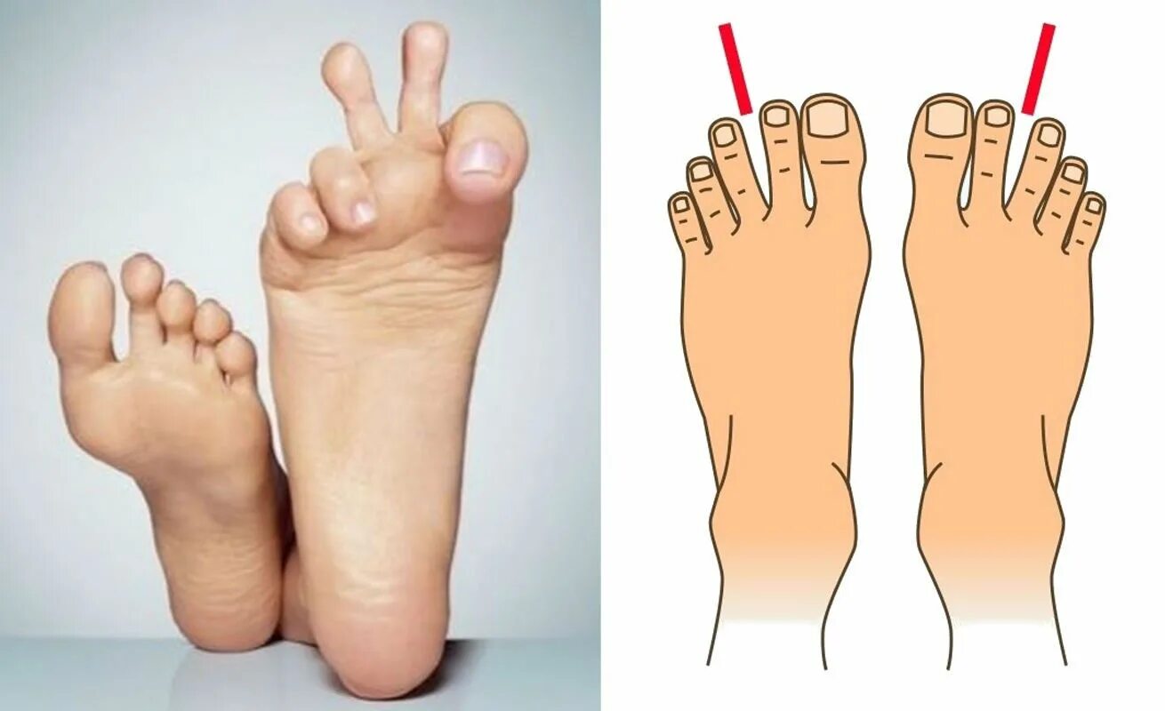 Форма стопы. Форма пальцев на ногах. Типы форм пальцев на ногах. 3 типа стопы