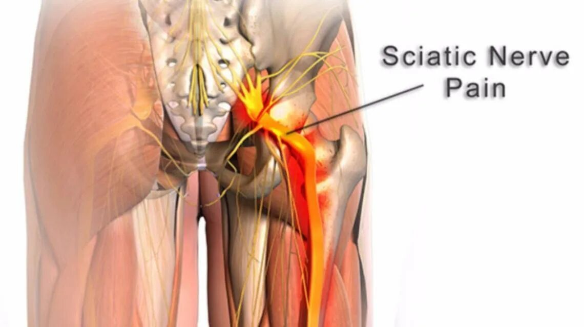Седалищный нерв в колене. Защемление седалищного нерва анатомия. Защемление пахового нерва. Поясницы отдающая в пах