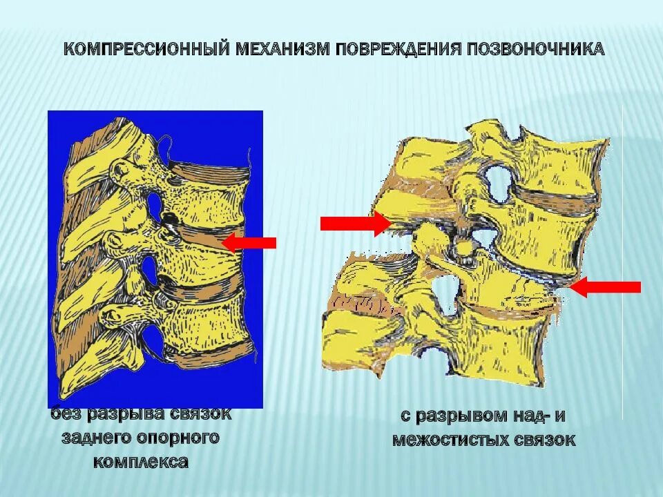 Механизм компрессионного перелома позвоночника. Компрессионный перелом позвонков по степеням. Механизм компрессионного перелома позвонка. Компрессионный перелом позвоночника 1с 8.