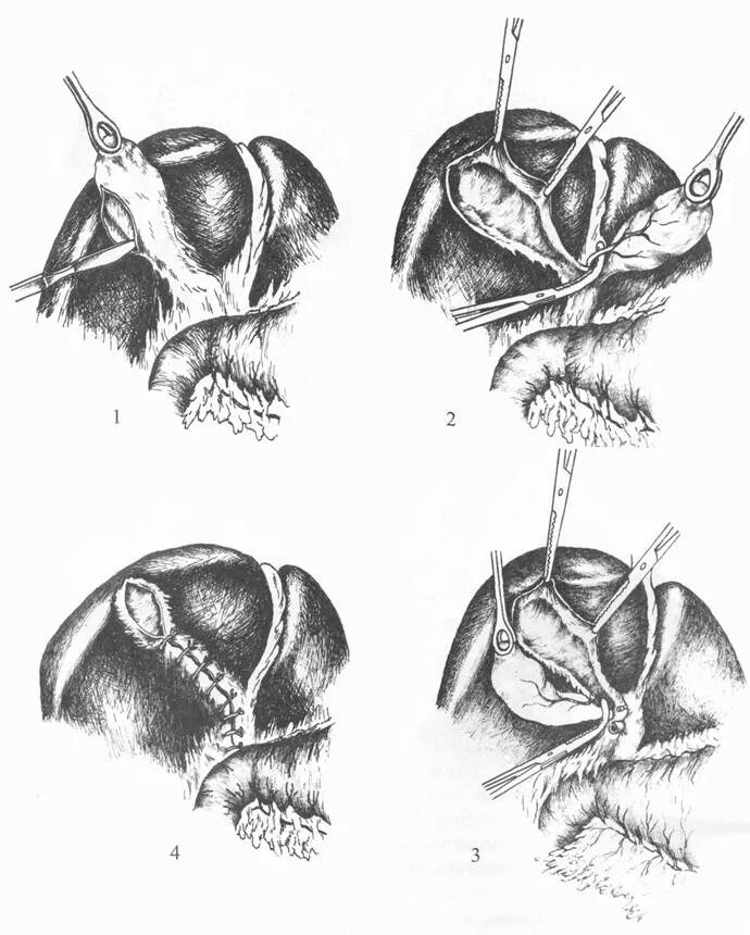 Катетер фогарти холедохотомия. Операция на желчных протоках. Дренирование внутрипеченочных желчных протоков. Операция на желчных протоках. Катетер дормиа.