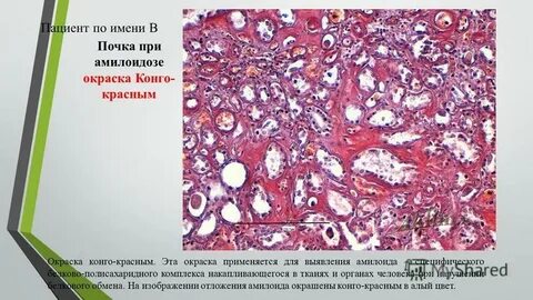Амилоидоз почки описание