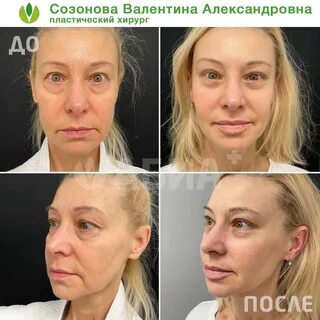 Отзывы пластические хирурги блефаропластика