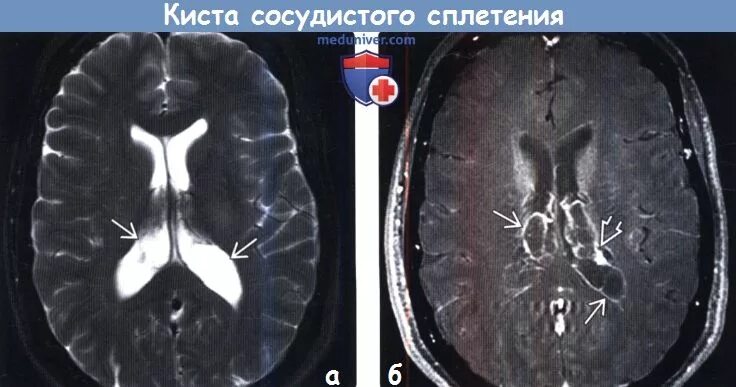 Ксантогранулемы сосудистых сплетений боковых желудочков мрт. Кисты боковых желудочков мозга мрт. Липома бокового желудочка мозга кт. Киста бокового желудочка мозга кт.