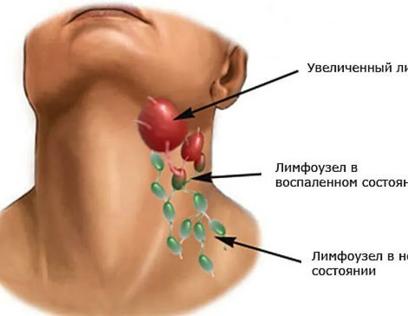 Почему постоянно воспаляется. Поднижнечелюстные лимфоузлы узлы. Поверхностные шейные лимфоузлы увеличены. Воспалились шейные лимфоузлы причины. Грудные лимфоузлы воспаление.