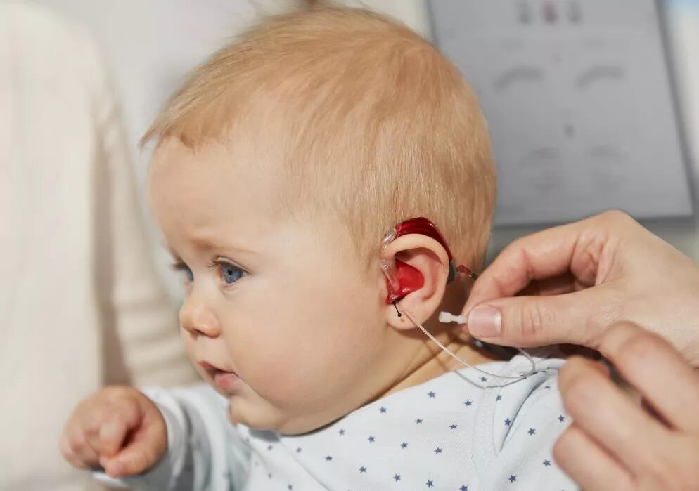 Слышать месяц. Кохлеарная имплантация Cochlear. Кохлеарная имплантация что это такое у ребенка. Слухопротезирование и кохлеарная имплантация. Аппарат для глухих кохлеарная имплантация.