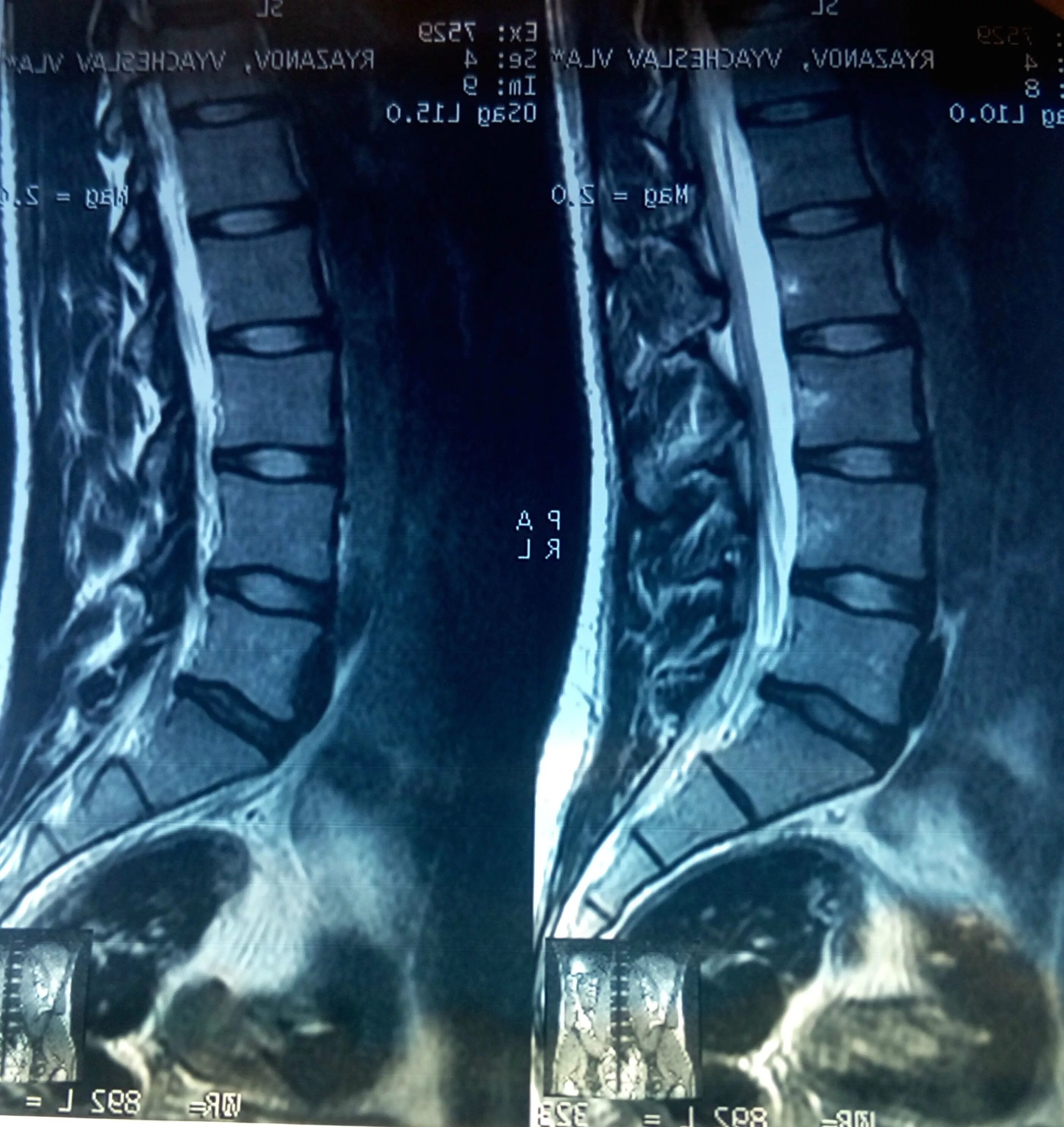 L4 l5 отдел позвоночника протрузия. Диски l5-s1 в позвоночнике. Грыжа l5-s1. Сегмент позвоночника l5-s1. L5 s1.