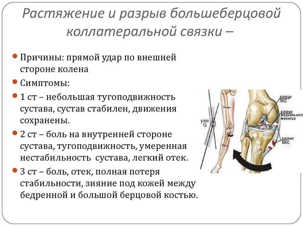 Диагностика повреждений боковых связок. Признаки повреждения медиальной боковой связки коленного сустава. При повреждении связки коленного сустава. Повреждение связочного аппарата левого коленного сустава. Код по мкб растяжение связок коленного сустава