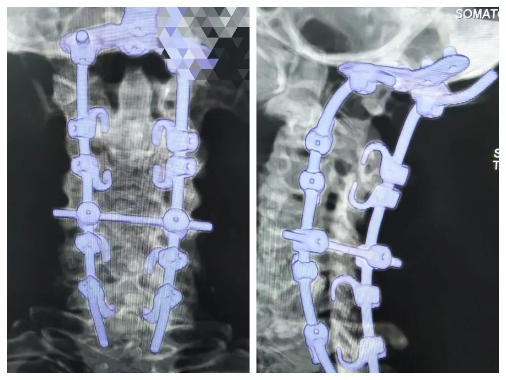 Кейдж передний спондилодез. Остеосинтез позвоночника l1 транспедикулярной. Передний спондилодез l5. Транспедикулярная фиксация l3 l4. Операция на позвоночник с металлоконструкцией инвалидность