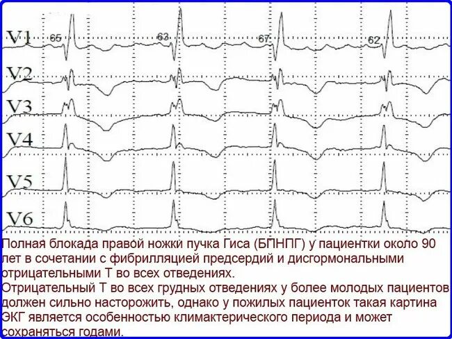 Блокада пучка гиса на экг у ребенка. ЭКГ фибрилляция предсердий блокада правой пучка Гиса. Блокада ПНПГ на ЭКГ. ЭКГ при полной блокаде ножек пучка Гиса. Блокада правой ножки пучка Гиса на ЭКГ.