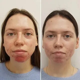 Пилинг джесснера до и после для лица