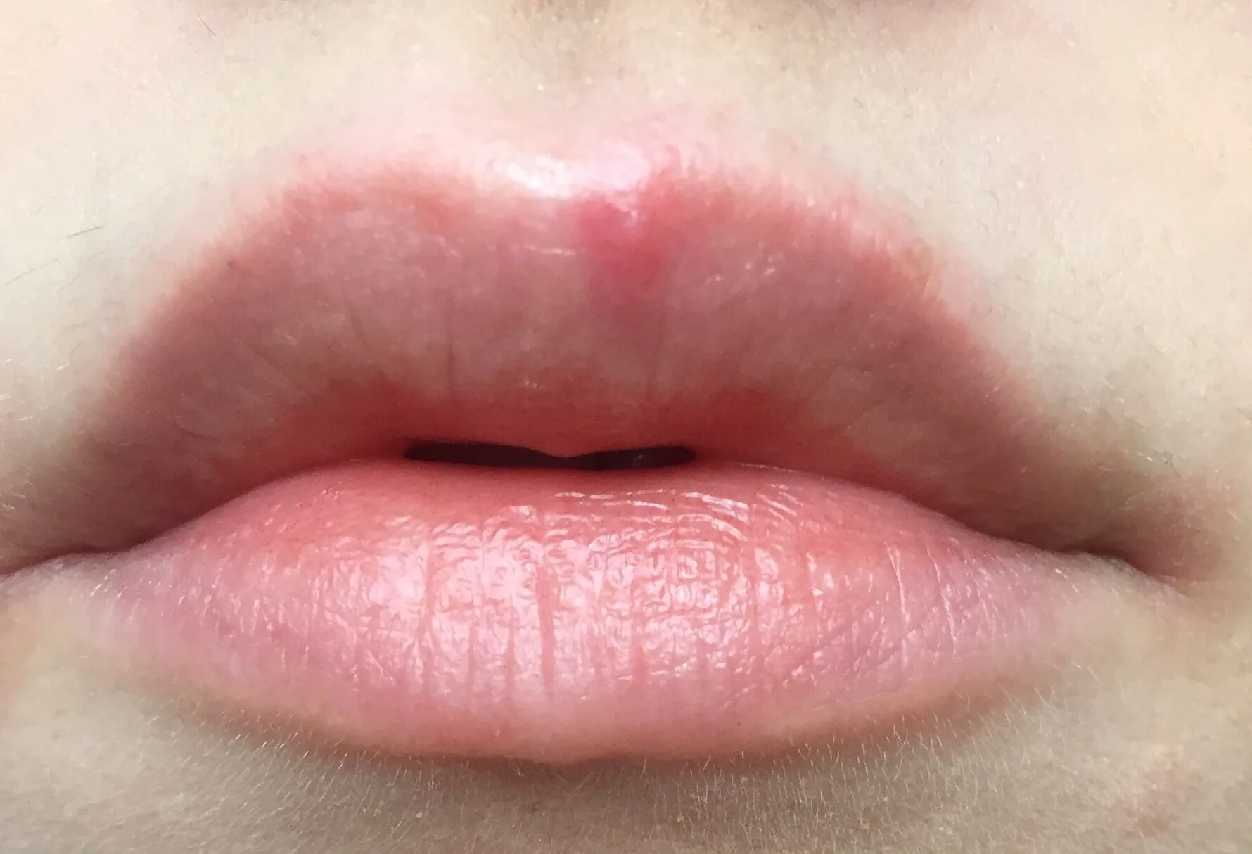 Аллергический дерматит на губах. Губы после сигарет