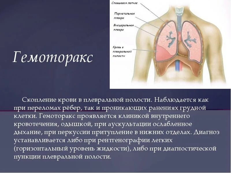 Травма плевральной полости. Клапанный спонтанный пневмоторакс. Гемоторакс топографическая анатомия. Травма плевральной полости. Клапанный пневмоторакс схема.