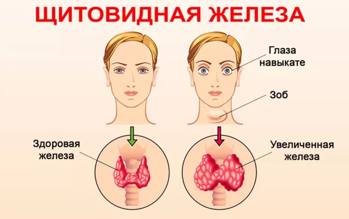 Гиперплазия щитовидной железы что это такое. Заболевания щитовидной железы. Заболевание щитовиднойжелезв. Щитовидная железа симптомы заболевания. Признаки больной щитовидки.