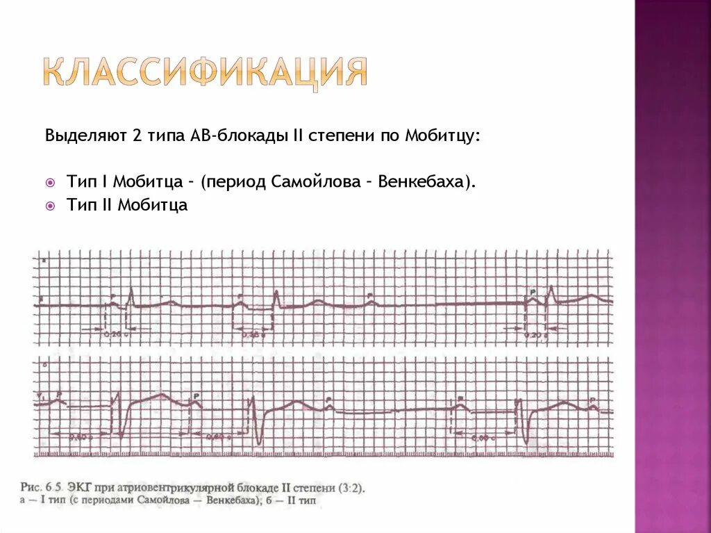 Блокада 2 типа. Ав блокада 2 степени самойлова венкебаха. ав блокада 2 степени мобитц 1 с периодикой самойлова венкебаха. aв блокады 2 степени с периодами самойлова венкебаха. периоды самойлова-венкебаха на экг.