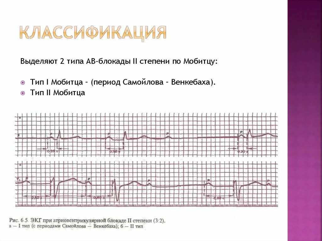 Блокады 2 степени армия. АВ блокада 2 степени Самойлова Венкебаха. АВ блокада 2 степени Мобитц 1 с периодикой Самойлова Венкебаха. Периоды Самойлова-Венкебаха на ЭКГ. AВ блокады 2 степени с периодами Самойлова Венкебаха.