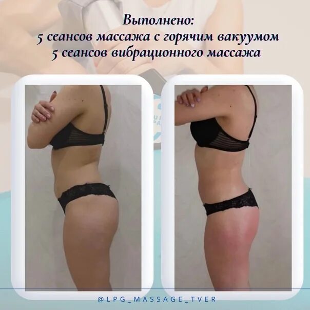 Результаты от вакуума живота. Старвак вакуумный массаж. Вакуумная подтяжка живота. Вакуумный массаж живота до и после. Вакуум отзывы форум.
