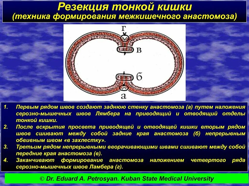 Как восстановить кишечник после операции. Техника резекции тонкой кишки. Резекция тонкой кишки этапы. Резекция тонкой кишки и анастомозы.