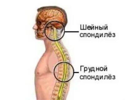 Шейный остеохондроз сколько длится обострение