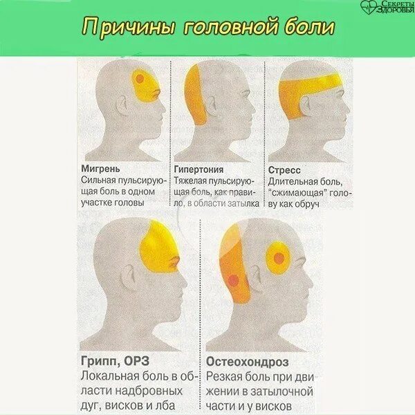 Схема локализации головной боли. Причины головной боли. Боль в затылке у мужчин