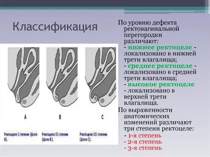 Цистоцеле и ректоцеле