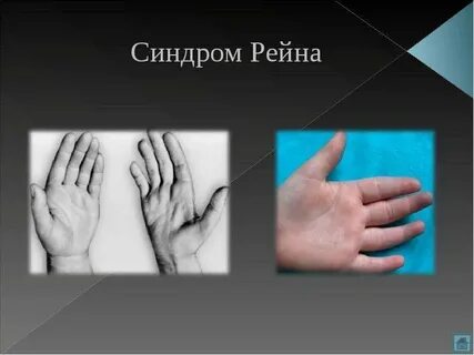 Синдром рейна