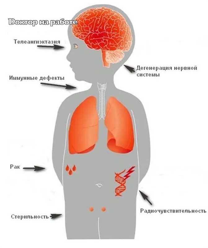 Синдром луи барра. Синдром атаксии-телеангиэктазии (синдром луи-бар). синдром луи бар патогенез. синдром луи бар иммунология. синдром атаксии-телеангиэктазии (луи-бар).