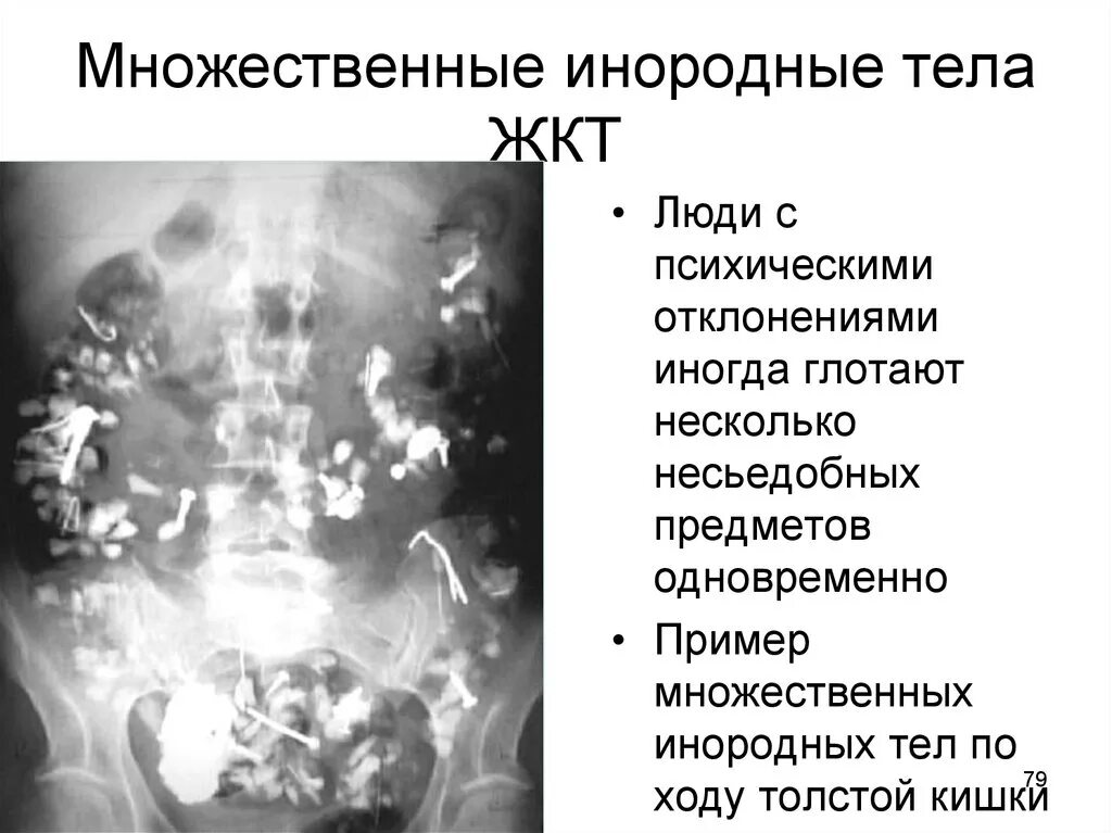 Инородное тело брюшной полости после операции. Инородные тела пищеварительного тракта. Инородные тела желудочно-кишечного тракта у детей. Инородный предмет в теле. Рентген инородное тело в ЖКТ.