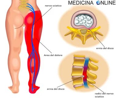 Sciatica: quanto dura, come dormire, come farla passare, consigli e prodotti con
