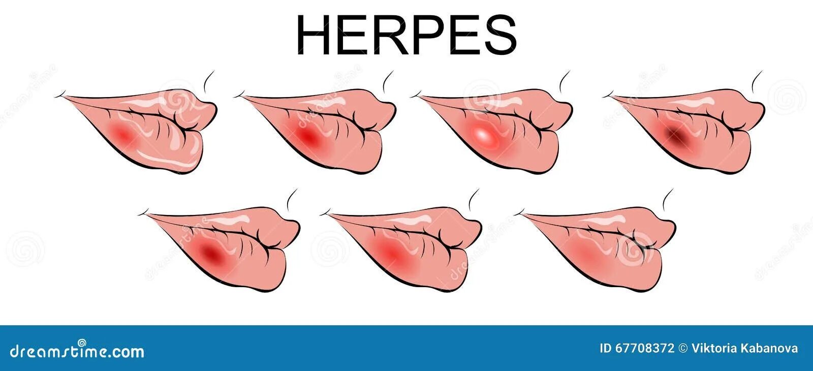 Illustration of Herpes Zoster Stock Vector - Illustration of infection, paunch: 