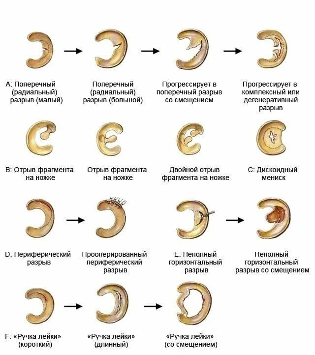 Радиальный разрыв мениска 3 степени. Повреждение мениска коленного сустава классификация. Разрывы мениска коленного сустава классификация. Повреждение мениска коленного сустава классификация Stoller. Мениск коленного сустава лечение в домашних условиях