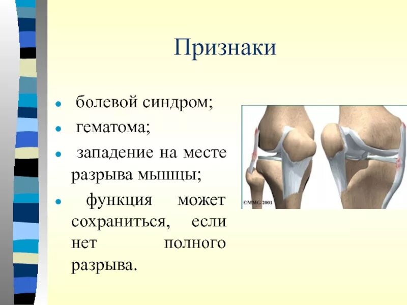 Разрыв мышц признаки. Признаки полного разрыва мышц. Разрывы мышц клинические проявления. Симптомы повреждения мышц.