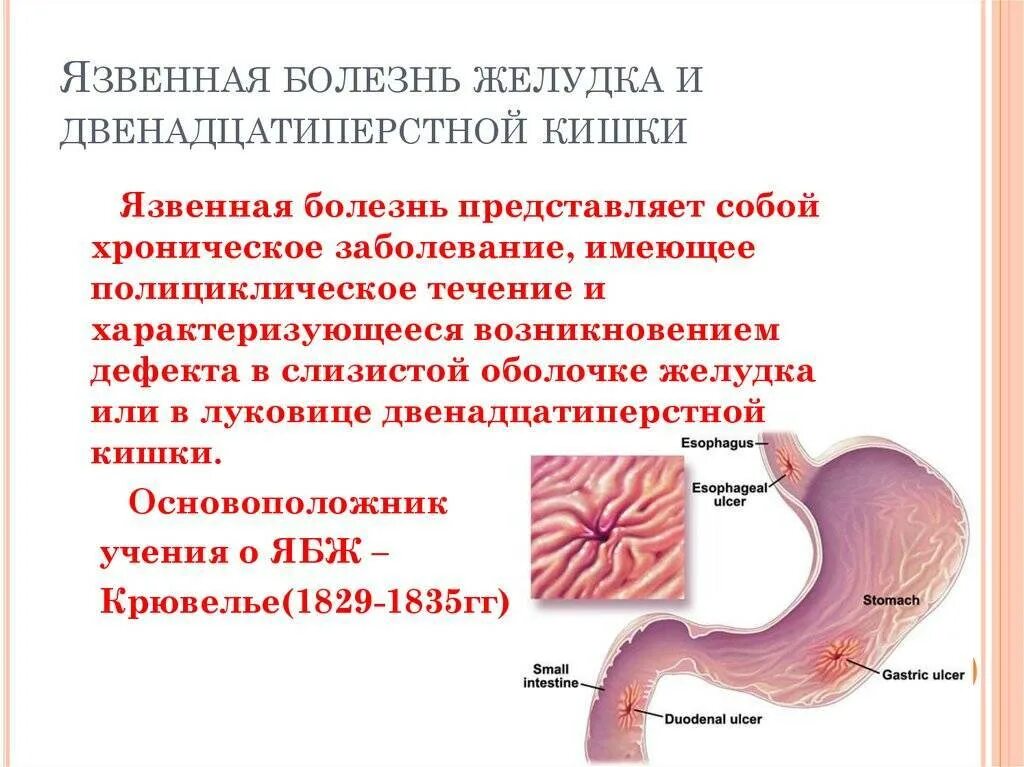 Язвенная болезнь болезнь желудка и 12 перстной кишки. Основные симптомы язвенной болезни желудка и 12-перстной кишки. Клинические симптомы язвенной болезни 12-перстной кишки. Язва двенадцатиперстной кишки к26. Язва симптомы и лечение у взрослых