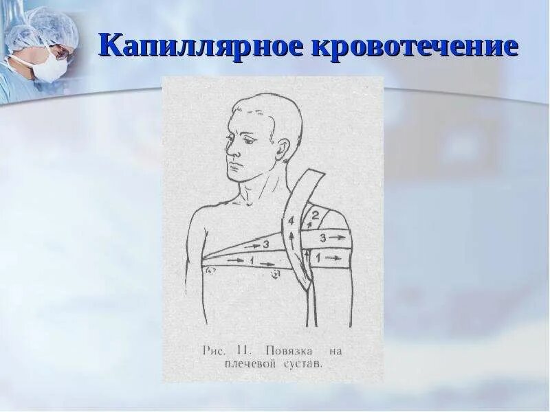 Наложение тугой повязки при кровотечении. Капиллярное кровотечение повязка. наложение повязки при капиллярном кровотечении. перевязка при капиллярном кровотечении. капиллярное кровотечение повязка на сустав.