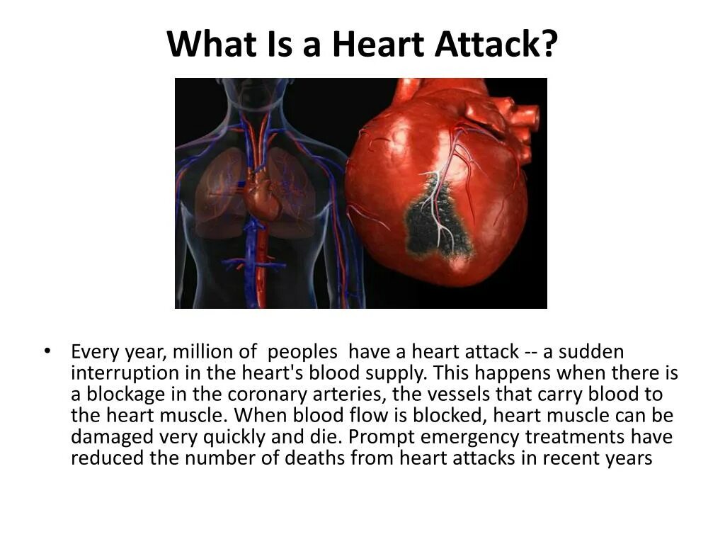Heart attack speed up. Heart attack speed up