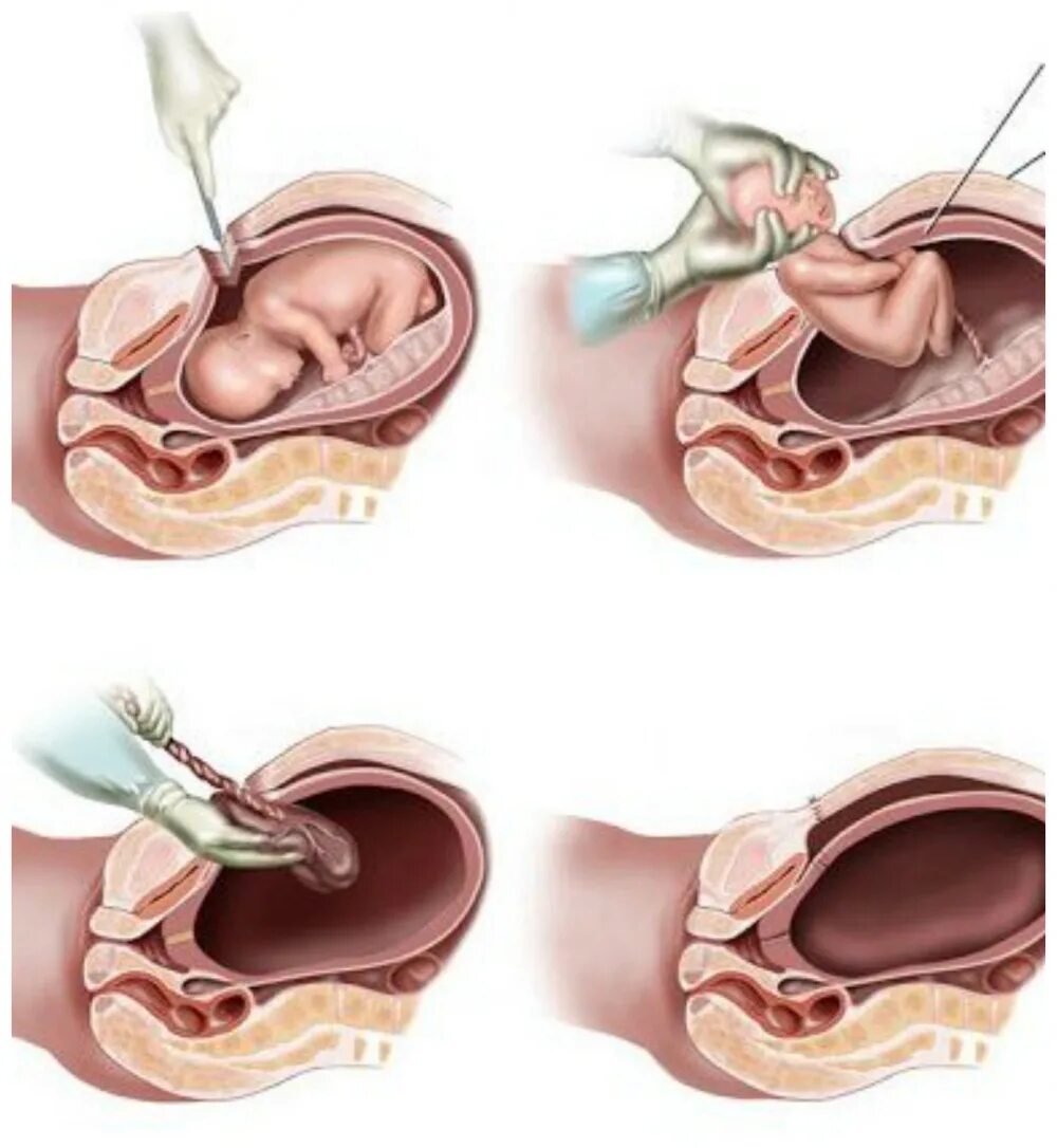 Через сколько после родов матка. Разрез после кесарева сечения. Кесарево сечение матка.
