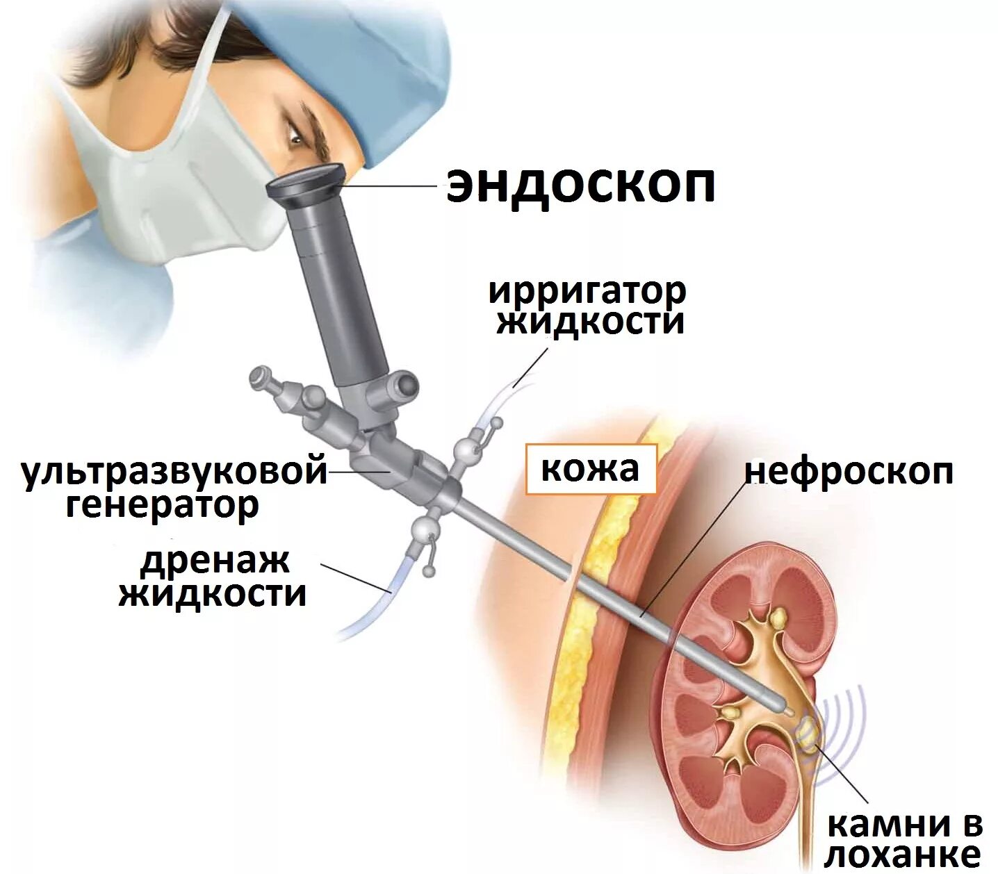 Мочекаменная болезнь мочеточника. Перкутанная нефролитотрипсия. Перкутанная нефролитотрипсия (нефролитолапаксия). Перкутанная литотрипсия камней почек. Чрескожная литотрипсия камней в почках.