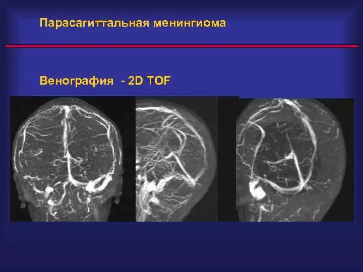 Венография головного мозга. Парасагиттальная менингиома кт. Локализация менингиом головного мозга. Менингиома парасагиттальная лобной доли. Парасагиттальная менингиома левой лобной области.