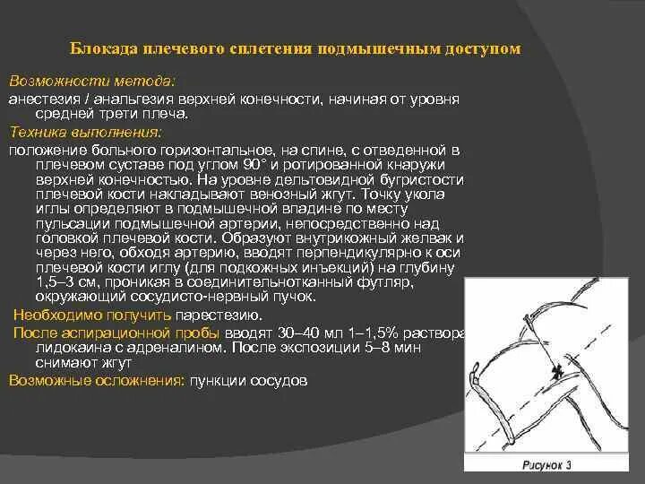 Блокада сплетения. Регионарная анестезия плечевого сплетения. Блокада плечевого сплетения подмышечным доступом. Проводниковая анестезия подмышечным доступом техника. Проводниковая блокада плечевого сплетения по Соколовскому.