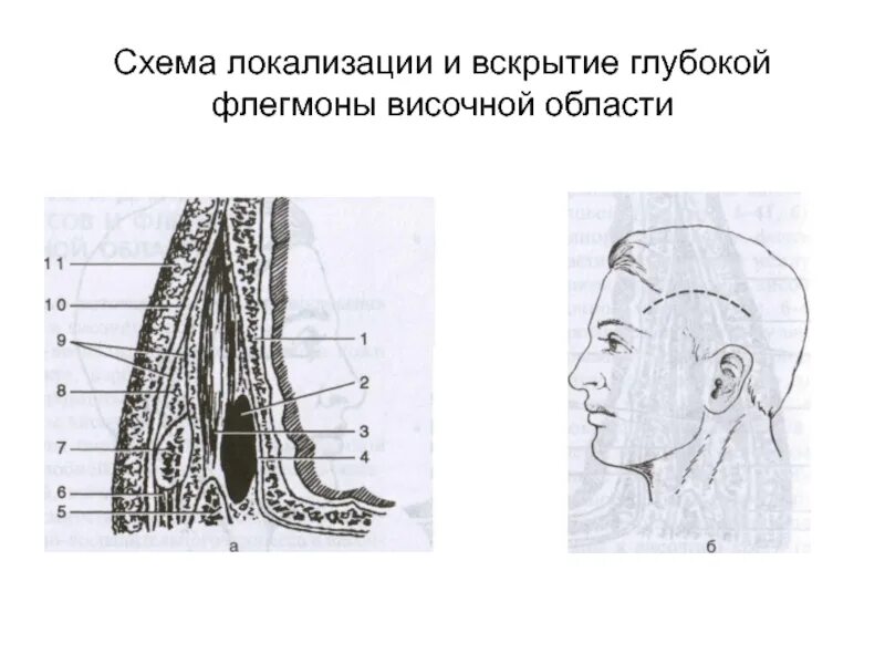 Линии разрезов при вскрытии флегмон предплечья. Линии разрезов при вскрытии флегмон предплечья